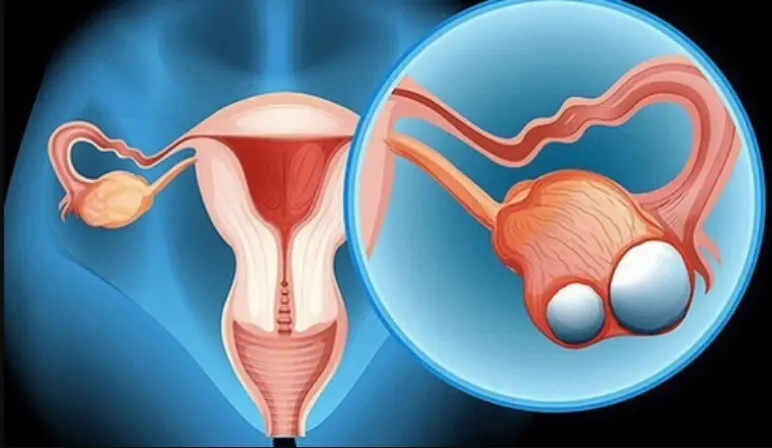 Bệnh u nang buồng trứng là gì và thường gặp ở độ tuổi nào?