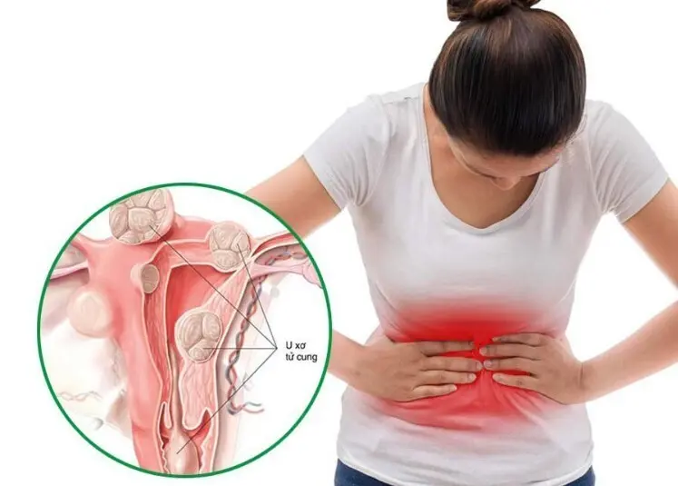 Bệnh u xơ tử cung có nguy hiểm không? Khi nào cần can thiệp?