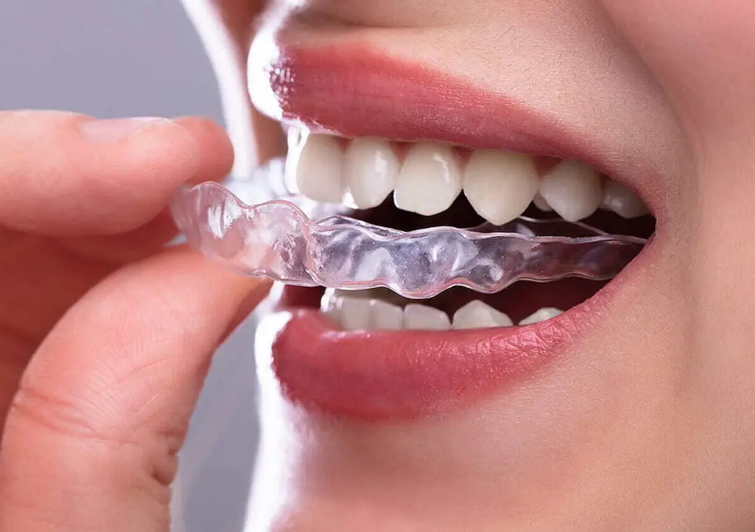Niềng Răng Trong Suốt: Hiểu Chi Phí Và Lộ Trình Trước Khi Bắt Đầu