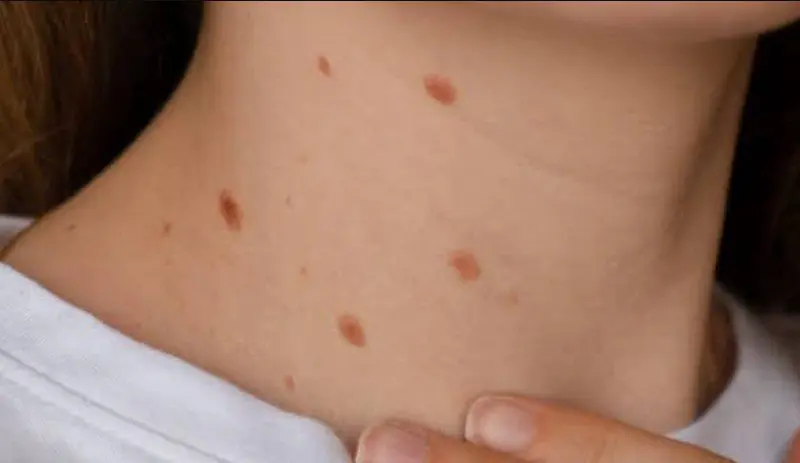 Bệnh sùi mào gà là bệnh gì? Đặc điểm, dấu hiệu và hướng xử trí