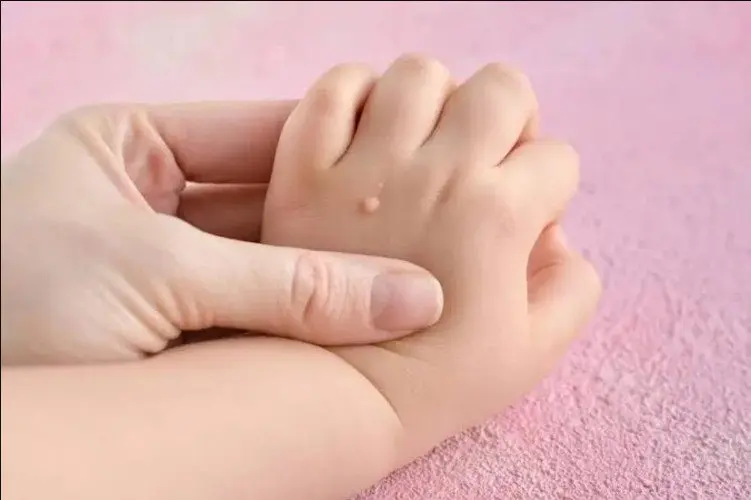 Trẻ em bị sùi mào gà: Nhận biết và xử trí như thế nào?