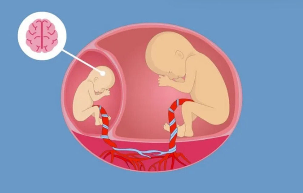 Quản lý thai thai đôi 1 bánh rau 2 buồng ối như thế nào để giảm rủi ro?