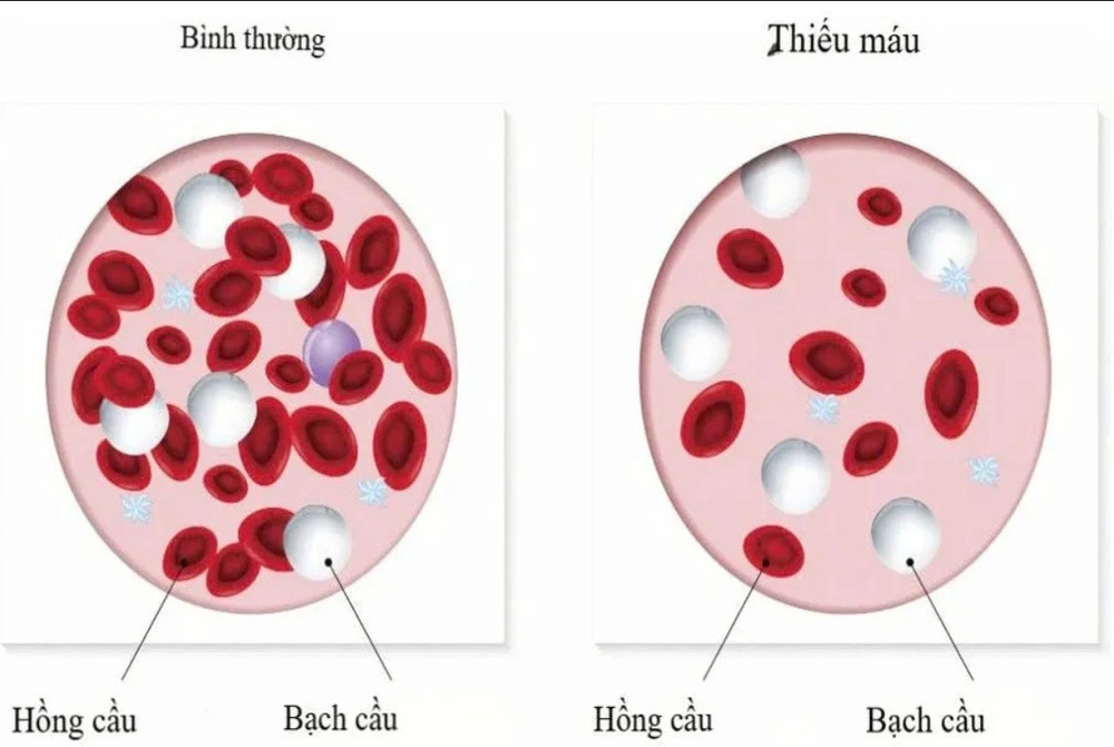 Nguyên nhân và hướng điều trị an toàn cho thai bị thiếu máu